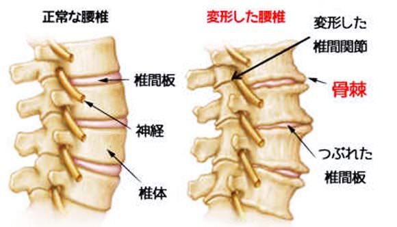 変形性腰椎症を表したイラスト
