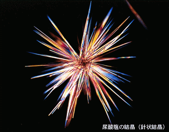 尿酸塩の結晶(針状結晶)の顕微鏡画像