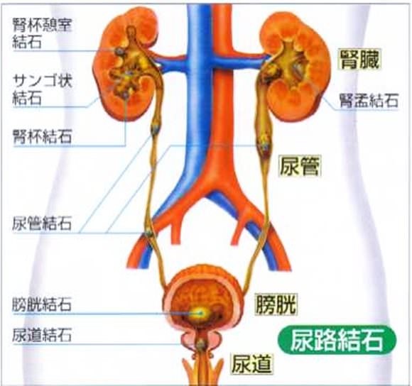 尿酸値が低すぎると尿路結石になるリスクも